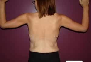 After Image: Arm Lift - back