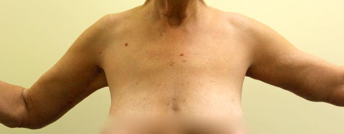 After Image: Arm Lift - front