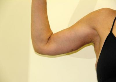 After Image: Arm Lift - front