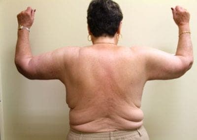 After Image: Arm Lift - back