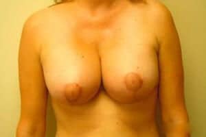 After Image: Breast Asymmetry - front