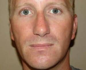 After Image: Chin Surgery - front