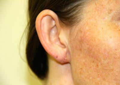 After Image: Ear Lobe Repair - right-front-oblique