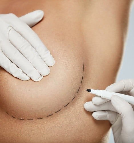 breast augmentation surgery la jolla