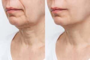 Before and after photos of the lower face show rejuvenation by tightening loose skin and eliminating wrinkles.