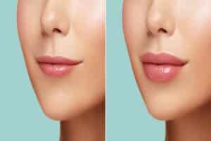Collagen injections can restore volume to the face when collagen decreases with age