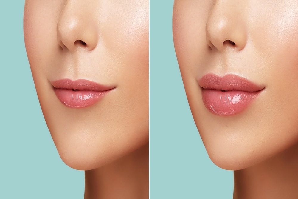 Collagen injections can restore volume to the face when collagen decreases with age