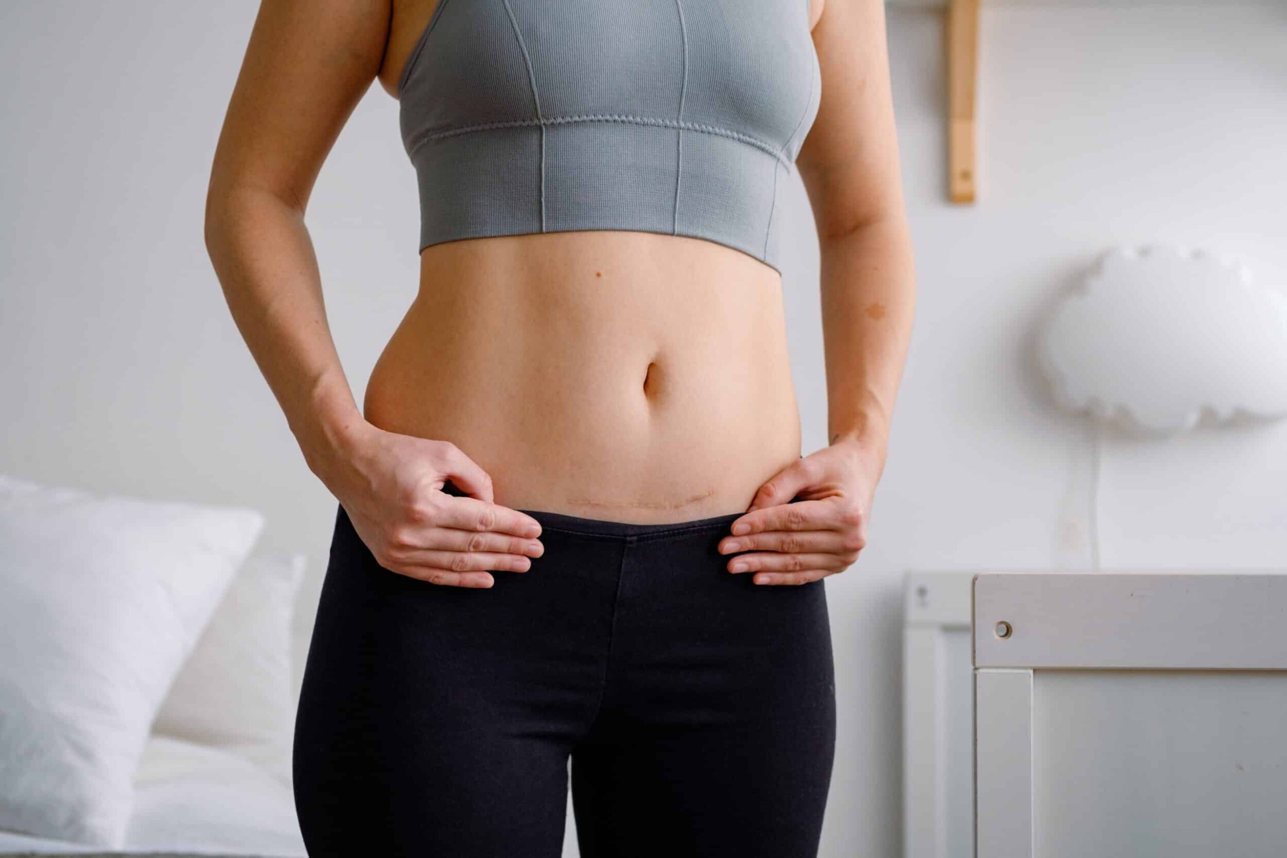 Woman has a C-section scar along her belly after having a baby