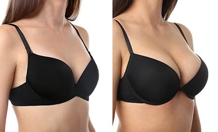 1774485363_breast-aug-1 Breast augmentation in Del Mar