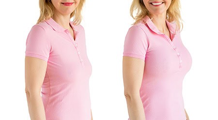 1774485371_breast-lift-1 Breast Lift in Del Mar