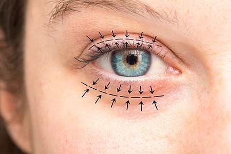 1774485386_eyelid-1 Eyelid Lift in Del Mar