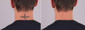 Tattoo Removal Procedure in Coronado, Ca