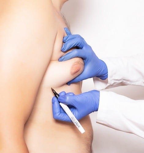 male breast reduction coronado