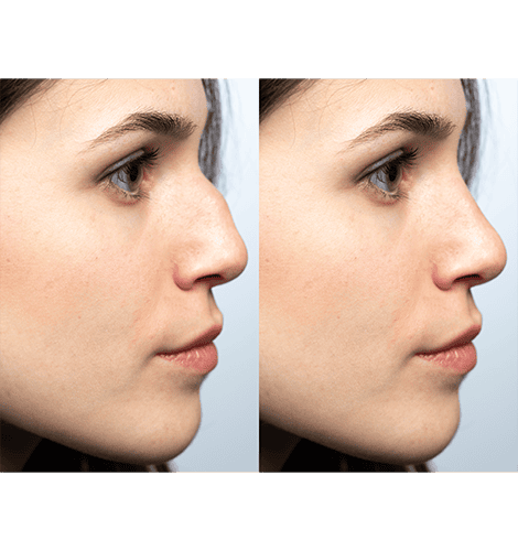 Coronado & La Jolla, CA Preservation Rhinoplasty Procedure