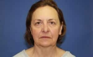 Before Image: Brow Lift - front