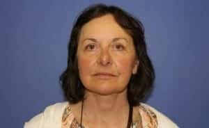 After Image: Brow Lift - front