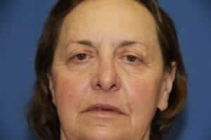 Before Image: Brow Lift - front