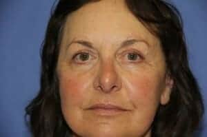 After Image: Brow Lift - front