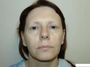 Before Image: Brow Lift - front