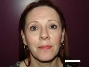 After Image: Brow Lift - front