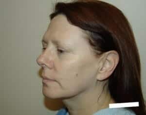 Before Image: Brow Lift - front