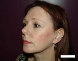 After Image: Brow Lift - front