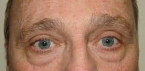 Before Image: Brow Lift - front