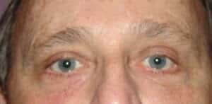 After Image: Brow Lift - front