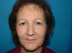 Before Image: Brow Lift - front