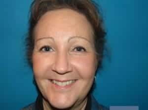After Image: Brow Lift - front
