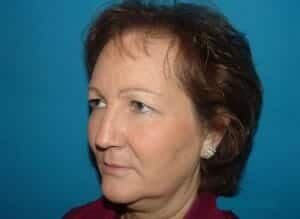 Before Image: Brow Lift - left-front-oblique