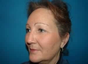 After Image: Brow Lift - left-front-oblique