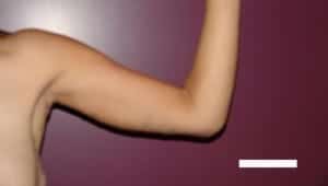 After Image: Arm Lift - front