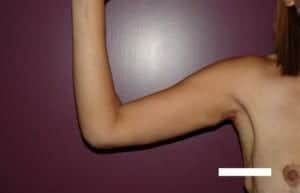 After Image: Arm Lift - front