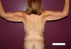 Before Image: Arm Lift - back