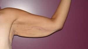 Before Image: Arm Lift - front