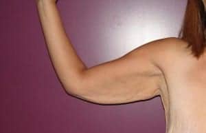 Before Image: Arm Lift - front