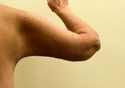 After Image: Arm Lift - back