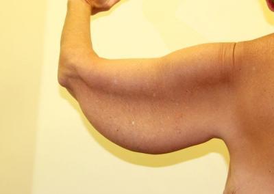 Before Image: Arm Lift - back