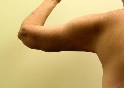 After Image: Arm Lift - back