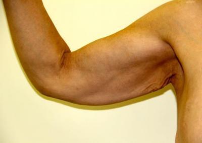 Before Image: Arm Lift - front