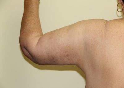 After Image: Arm Lift - back