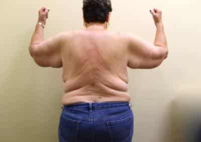 Before Image: Arm Lift - back