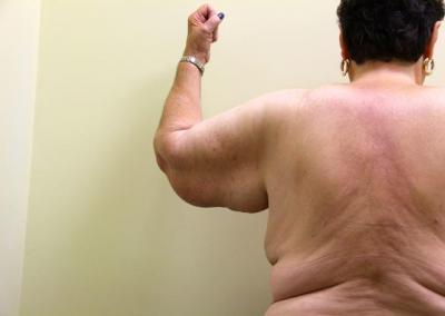 Before Image: Arm Lift - back