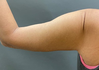 After Image: Arm Lift - back