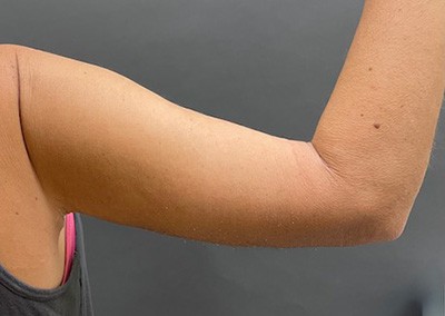 After Image: Arm Lift - back