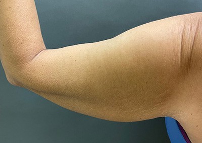 Before Image: Arm Lift - back