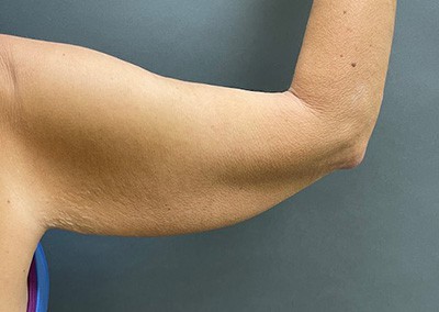 Before Image: Arm Lift - back