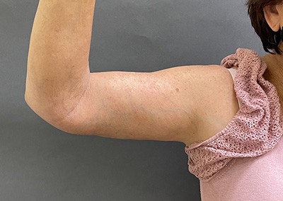 After Image: Arm Lift - front