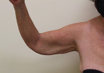 Before Image: Arm Lift - front